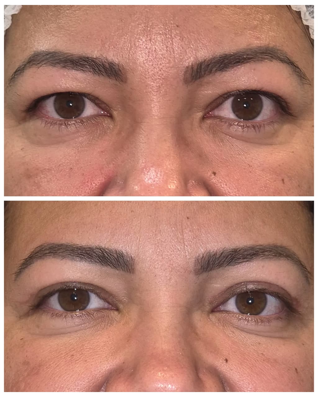 Antes e depois de blefaroplastia 14